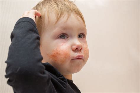 Eczema Atopic Dermatitis Allergy Testing Brisbane Allergy Testing