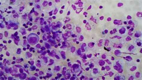 Poorly Differentiated Diffuse Type Adenocarcinoma Peritoneal Cytology