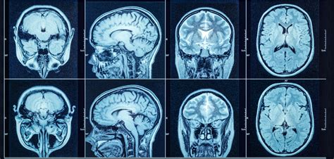 Do Ct Scans Show Concussions Or Post Concussion Syndrome