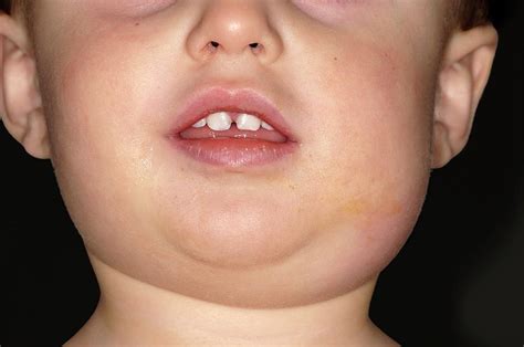 Mumps Photograph By Dr P Marazzi Science Photo Library