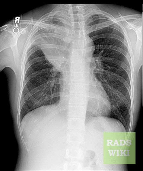 The Golden S Sign Is Seen On Both Pa Chest Radiographs And On Ct Scans