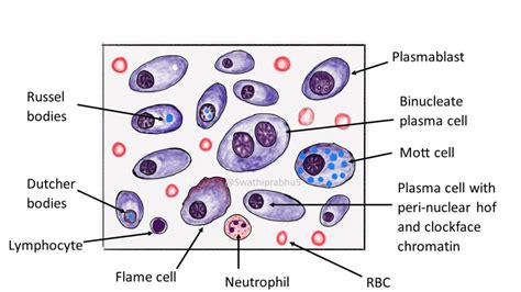 Pathology Of Multiple Myeloma Pathology Made Simple