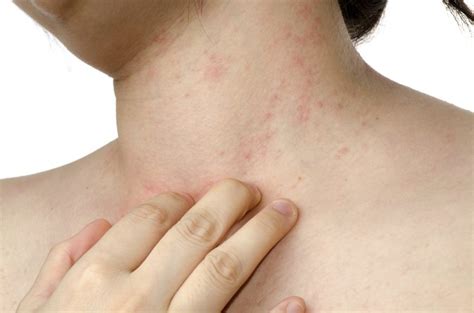 Causes Of Itchy Red Bumps On The Neck LIVESTRONG COM