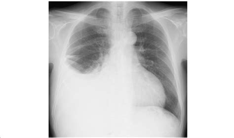 Chest X Ray Revealing Massive Right Sided Pleural Effusion Download Sexiz Pix