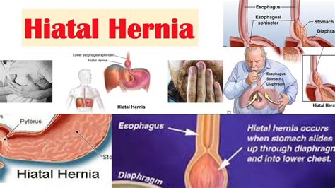 Hiatal Hernia Symptoms Causes Diagnosis And Treatment Youtube