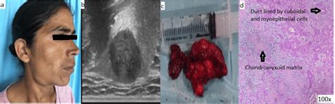 Case 1a Clinical Image Of Patient Showing Right Submandibular