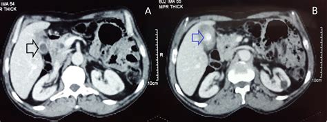 Cureus Gallbladder Tuberculosis Mimicking Gallbladder Carcinoma A