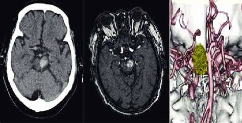 Ct Scan And Mri Image Showing Left Hyperdense Lesion In Ct And
