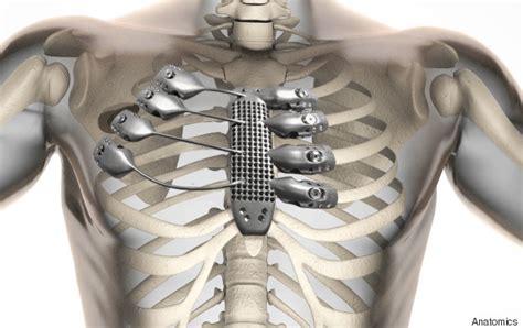 The thoracic cage (rib cage) is the skeletal framework of the thoracic wall, which encloses the thoracic cavity. 3D-Printed Titanium Rib Cage Designed For Cancer Patient ...