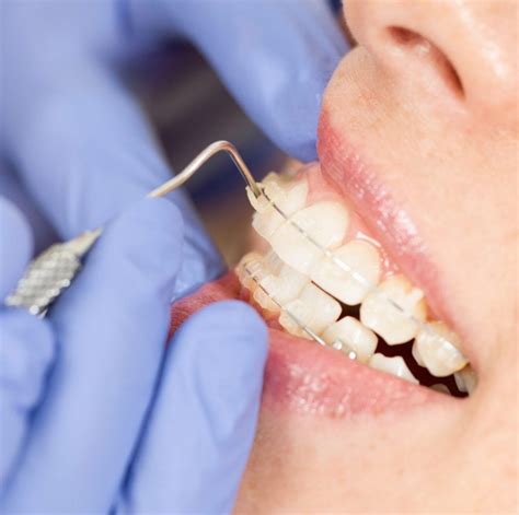 Ceramic Braces Vs Invisalign Schedule A Free Consultation Today