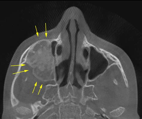 Cureus Radiographic Diagnosis Of Fibrous Dysplasia In Maxilla