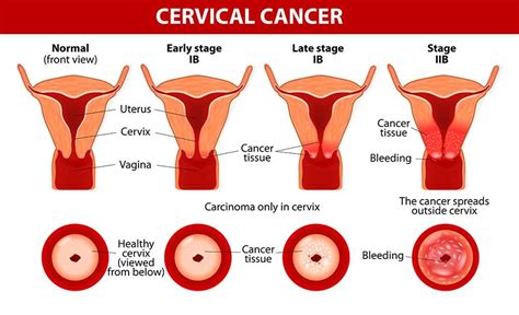 Cervical Cancer Symptoms 10 Warning Signs Of Cervical Cancer