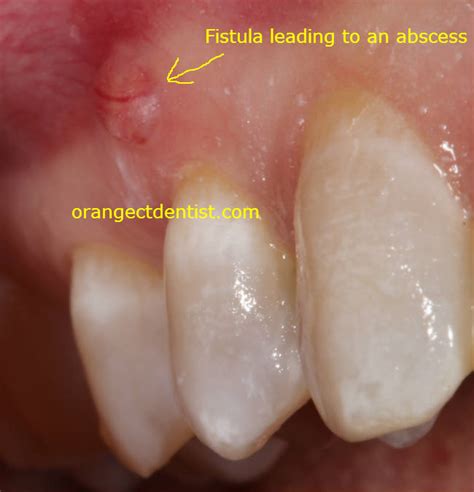 Dental Abscess Or Infection Dentist West Haven Milford Ct