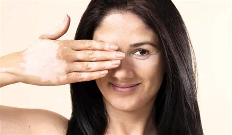 How To Get Rid Of Light Spots On Skin Possible Causes And Treatments