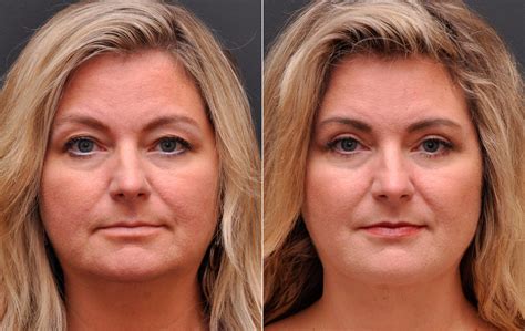 Blepharoplasty Photos Cincinnati Facial Plastic Surgery