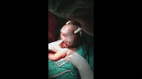 Huge Ovarian Dermoid Cyst Youtube