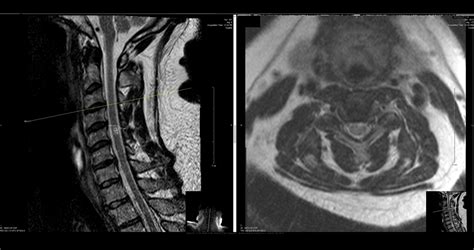 Mri Of Herniated Cervical Disc Dr Kevin Pauza
