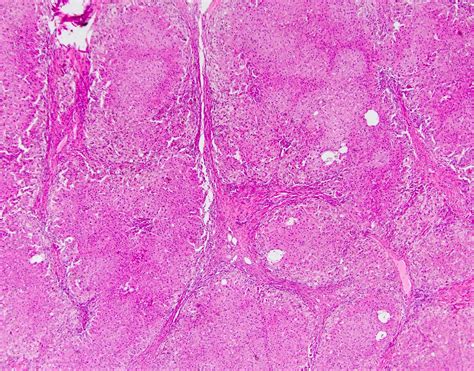 Pathology Outlines Secondary Biliary Cirrhosis