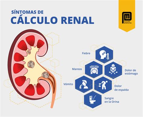 Calculo Renal Da Febre