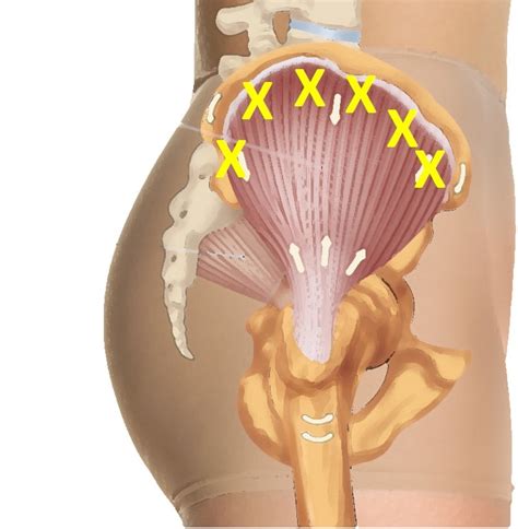 It will generate a textual output indicating which elements are in each intersection or are unique to a certain list. Athletic Trainers - Gluteal Tendinopathy, the PT Chronic Pain Denier Movement, and Circular ...