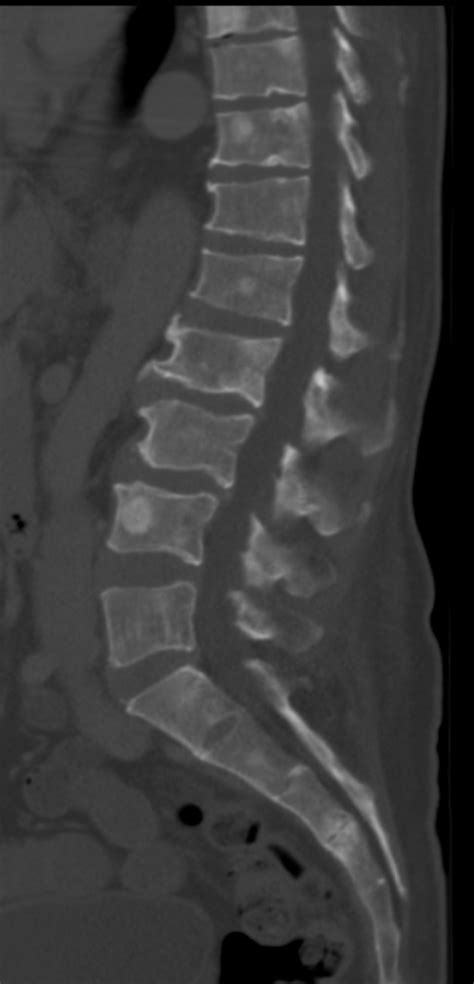 Filect Of Osteoblastic Lesions Of Multiple Myeloma Wikipedia