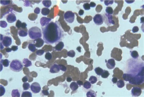 Bone Marrow Showing Megakaryocyte With Increased Platelet Budding