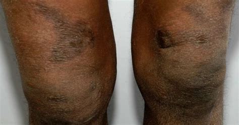 Light Skin Discoloration On Legs