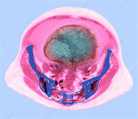 Ovarian Cancer Ct Scan Stock Image M8500541 Science Photo Library