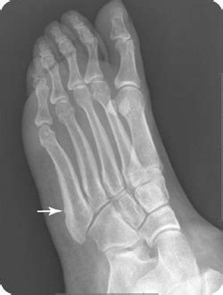 When there is significant displacement a in rare situations it may be necessary to undertake reconstructive surgery which would repair not only the fracture (often with bone grafting). Fifth Metatarsal Fractures | Radiology Key