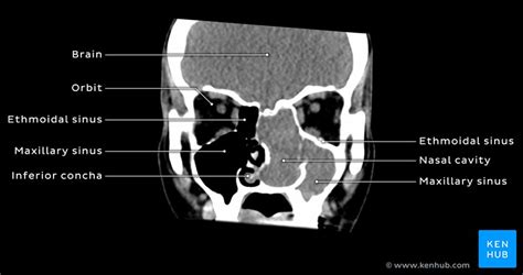 The nasal cavity anatomy is essential for both breathing and our sense of smell (olfaction). Schwannoma of the nasal cavity: Clinical case, diagnosis ...