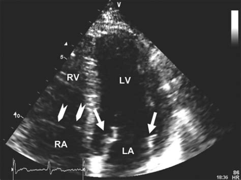 Figure 2marantic Endocarditis Associated With Pancreatic Cancer A