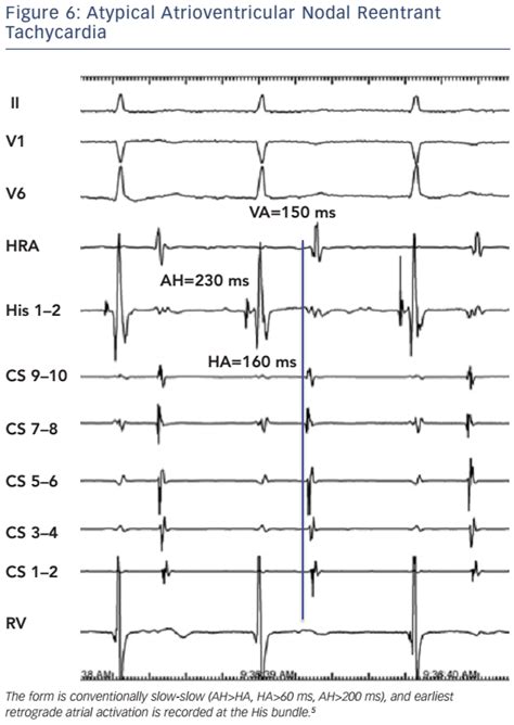 Figure Atypical Atrioventricular Nodal Reentrant Tachycardia Radcliffe Cardiology