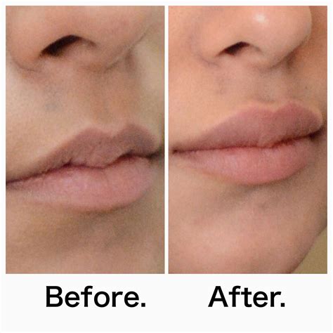 New Lip Injections Boston Get Some Extra Glow In Lips Lip Injections