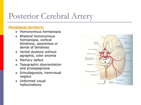 Right Posterior Cerebral Artery Stroke
