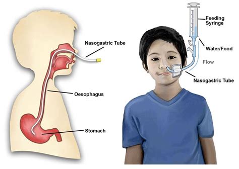 Using A Nasogastric Tube Gillette Childrens Specialty Healthcare
