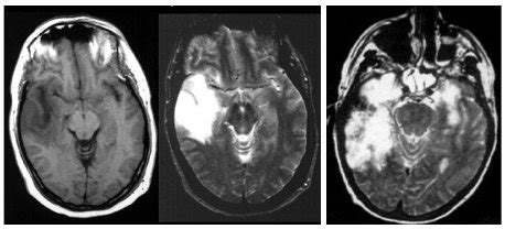 The severity can be variable with symptoms including reduced or alternation in consciousness, headache, fever, confusion, a stiff neck, and vomiting. ENCEFALITIS HERPETICA PEDIATRIA PDF