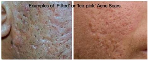 Tca Cross Improves Atrophic Icepick Acne Scars Update — The Aesthetic
