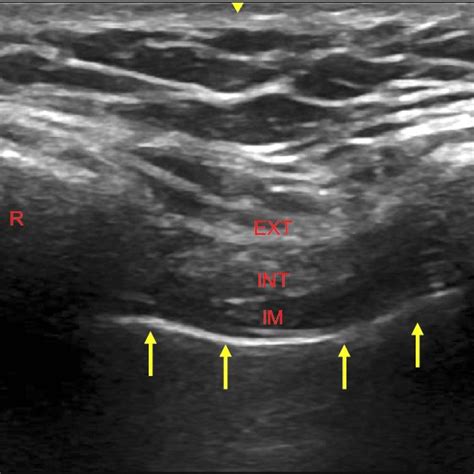 Ultrasound Image Of The Ilioinguinal And Iliohypogastric Nerve Blocks