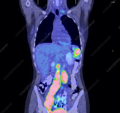 Hodgkins Lymphoma Ct And Pet Scan Stock Image M1340684 Science