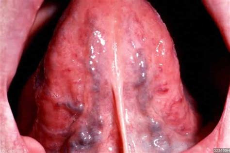 Black Spots On Tongue Under Small Pictures Causes Std Get Rid