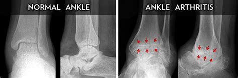 Ankle Arthritis Surgery Dr Neal Blitz New York Nyc