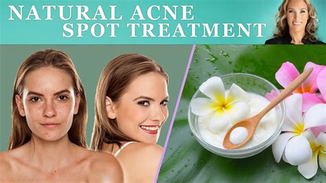 Natural Acne Spot Treatment Dr J9 Recipe Youtube
