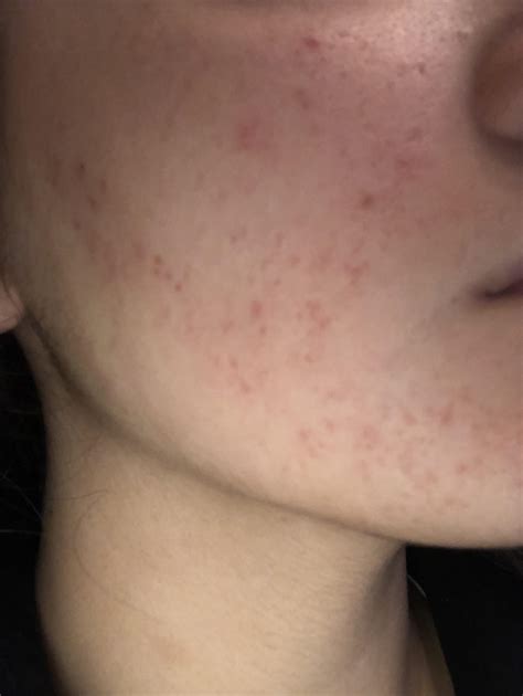 Skin Concerns Cant Seem To Find Anything That Works On My Hormonal