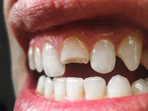 How To Fix A Broken Denture Tooth