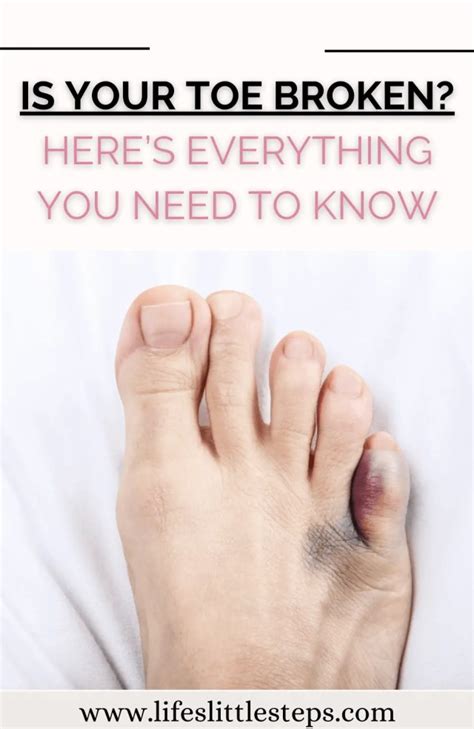 Broken Toe Causes Symptoms And Treatment Of Broken Toes