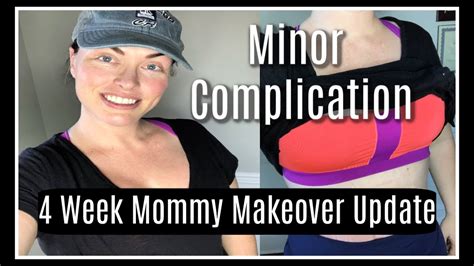Mommy Makeover Surgery Complications 4 Weeks Post Op Recovery Tummy