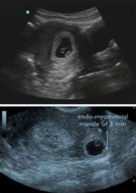 Brown Sound Ultrasound Diagnosis Of Ectopic Pregnancy — Brown