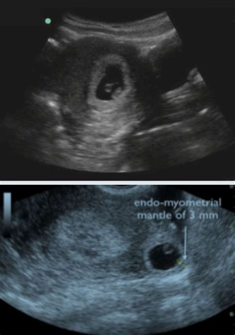 ectopic pregnancy ultrasound