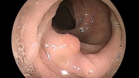 Trainees May Miss More Sessile Serrated Polyps On Colonoscopy MedPage