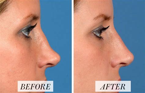Liquid Rhinoplasty Aka The Nonsurgical Nose Job Is A Quick Virtually Painless Procedure Done